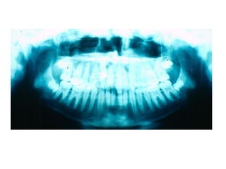 Transposição Total