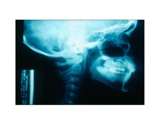 Transposição Total