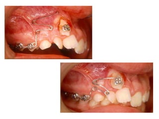 Transposição Total