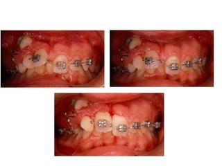 Transposição Total