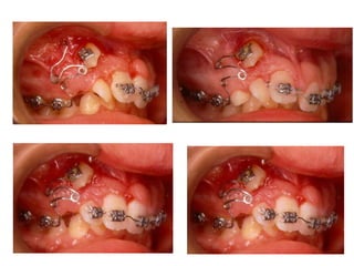 Transposição Total
