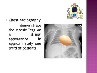 Transposition Of The Great Arteries X Ray