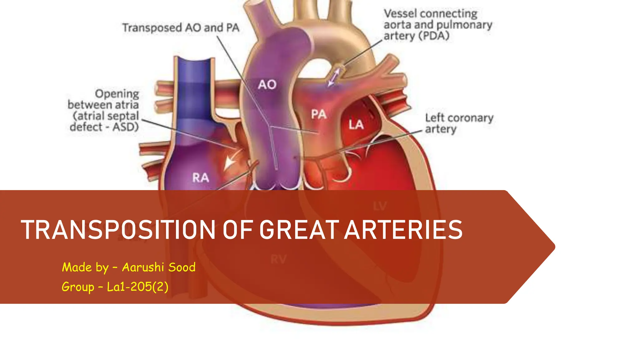 Transposition of Great Arteries(TGA) by Суд Ааруши.pptx