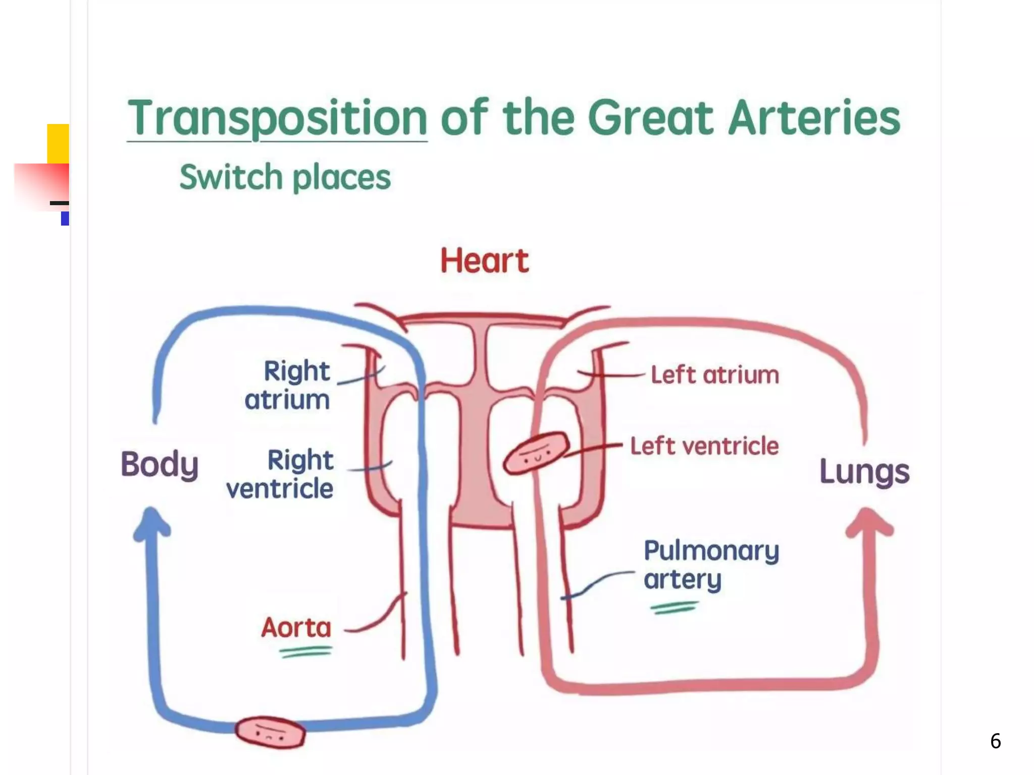 Transposition of the great arteries | PPT