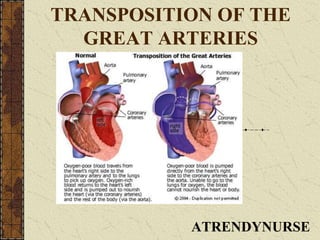 TRANSPOSITION OF THE
GREAT ARTERIES
ATRENDYNURSE
 