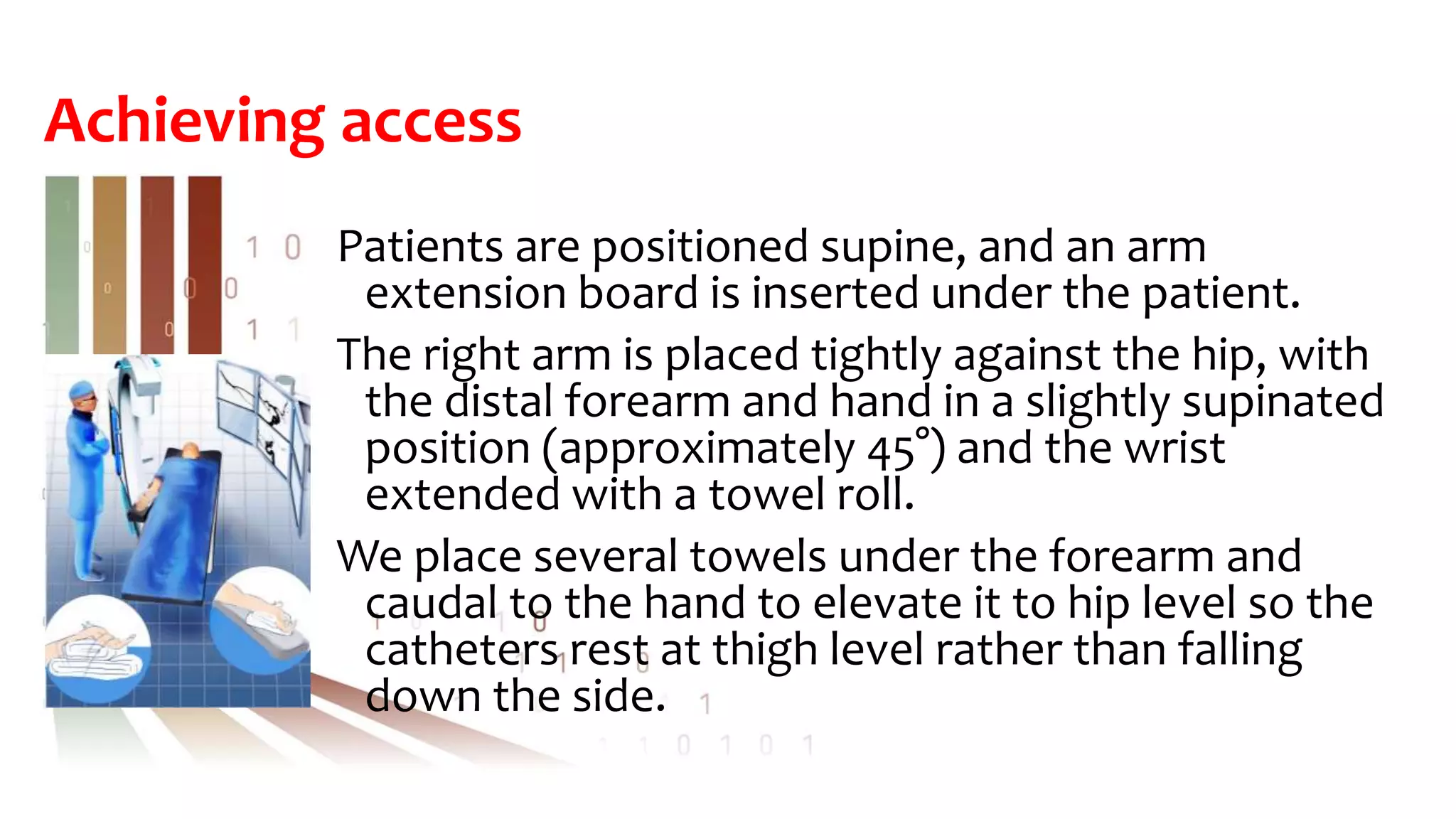 Achieving access
Patients are positioned supine, and an arm
extension board is inserted under the patient.
The right arm is placed tightly against the hip, with
the distal forearm and hand in a slightly supinated
position (approximately 45°) and the wrist
extended with a towel roll.
We place several towels under the forearm and
caudal to the hand to elevate it to hip level so the
catheters rest at thigh level rather than falling
down the side.
 