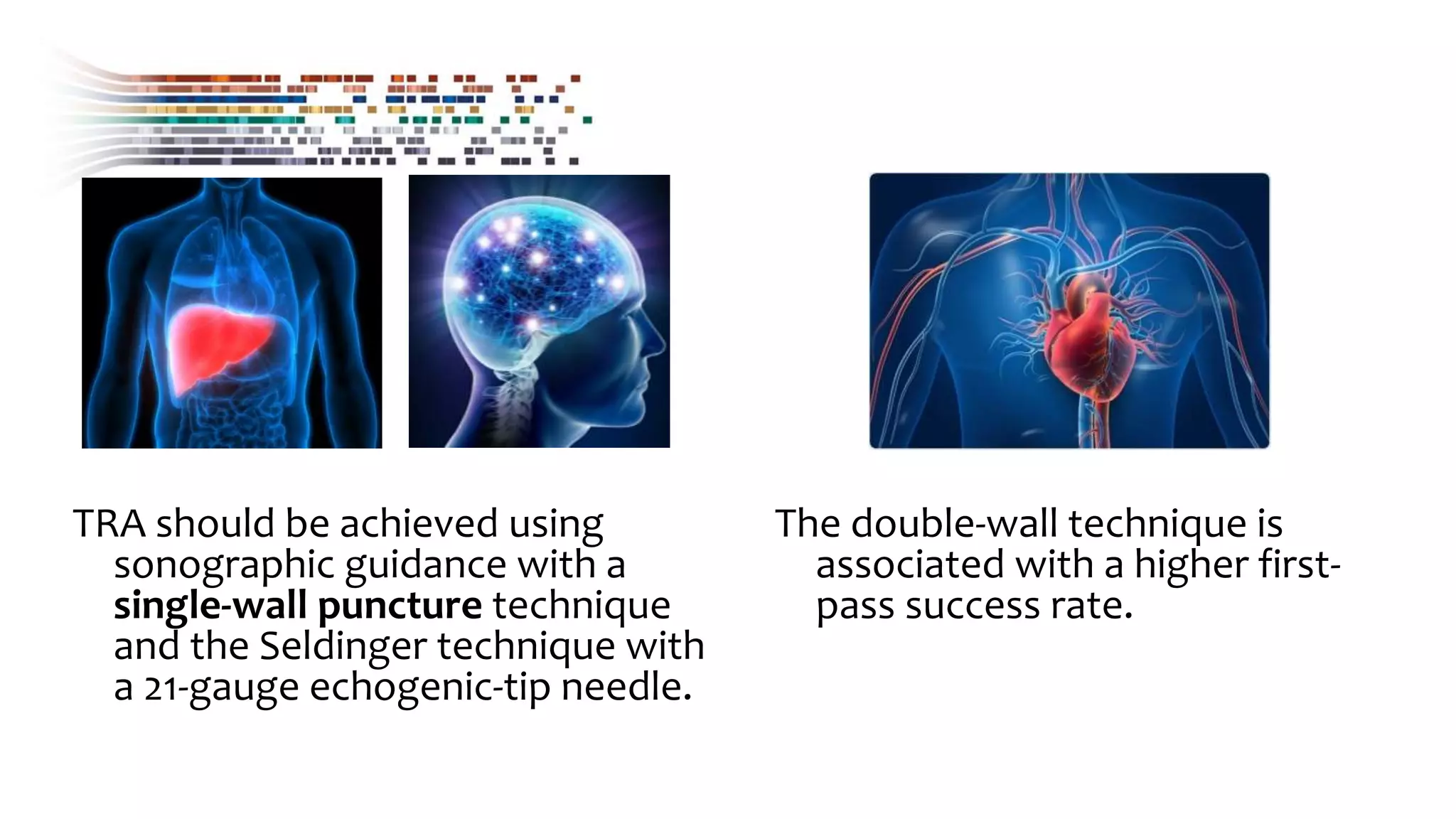 TRA should be achieved using
sonographic guidance with a
single-wall puncture technique
and the Seldinger technique with
a 21-gauge echogenic-tip needle.
The double-wall technique is
associated with a higher first-
pass success rate.
 