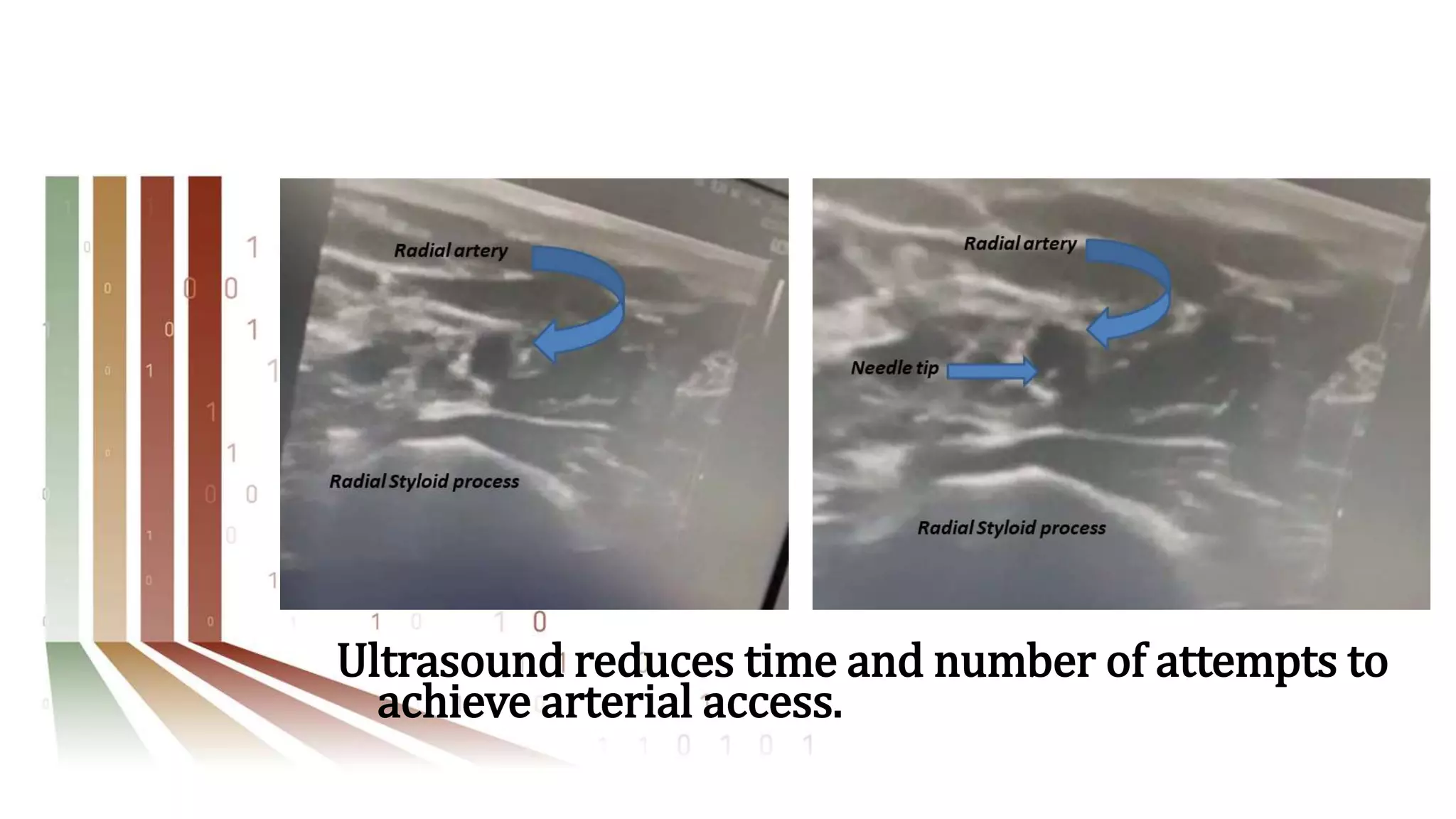 Ultrasound reduces time and number of attempts to
achieve arterial access.
 
