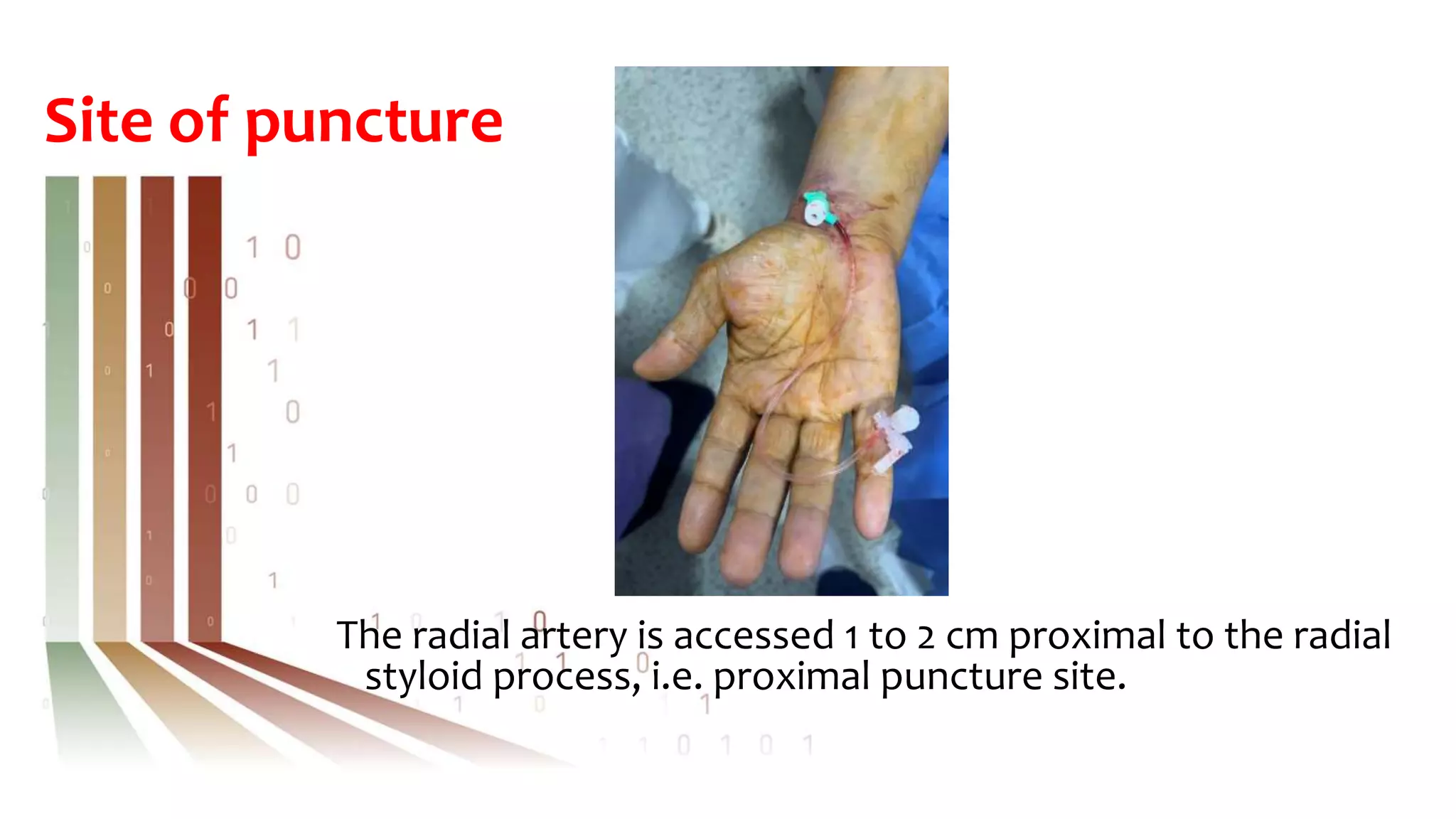 Site of puncture
The radial artery is accessed 1 to 2 cm proximal to the radial
styloid process, i.e. proximal puncture site.
 