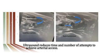 Ultrasound reduces time and number of attempts to
achieve arterial access.
 