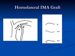 Homolateral IMA Graft
 