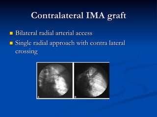 Contralateral IMA graft
n  Bilateral radial arterial access
n  Single radial approach with contra lateral
    crossing
 