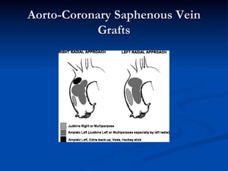 Aorto-Coronary Saphenous Vein
           Grafts
 