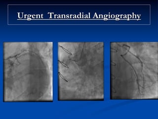 Urgent Transradial Angiography
 