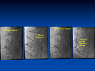 After Aspiration
SVG occlusion

                  Manual
                Aspiration
                                                  Injection
                                                through
                                                aspiration
                                                catheter
 