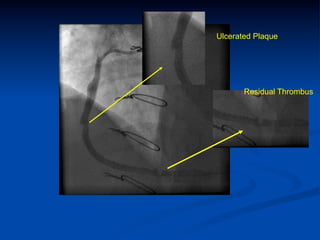 Ulcerated Plaque




       Residual Thrombus
 