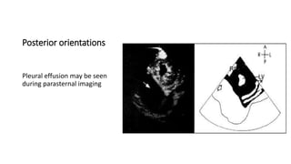 Posterior orientations
Pleural effusion may be seen
during parasternal imaging
 