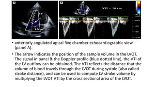 • anteriorly angulated apical five chamber echocardiographic view
(panel A).
• The arrow indicates the position of the sample volume in the LVOT.
The signal in panel B-the Doppler profile (blue dotted line), the VTI of
the LV outflow can be obtained. The VTI reflects the distance that the
column of blood travels through the LVOT during systole (also called
stroke distance), and can be used to compute LV stroke volume by
multiplying the LVOT VTI by the cross sectional area of the LVOT.
 