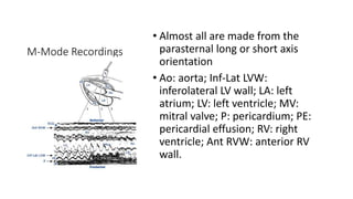 M-Mode Recordings
• Almost all are made from the
parasternal long or short axis
orientation
• Ao: aorta; Inf-Lat LVW:
inferolateral LV wall; LA: left
atrium; LV: left ventricle; MV:
mitral valve; P: pericardium; PE:
pericardial effusion; RV: right
ventricle; Ant RVW: anterior RV
wall.
 