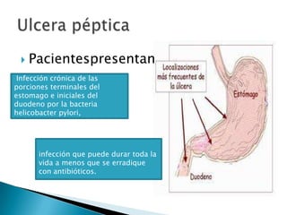  Pacientespresentan
infección que puede durar toda la
vida a menos que se erradique
con antibióticos.
Infección crónica de las
porciones terminales del
estomago e iniciales del
duodeno por la bacteria
helicobacter pylori,
 