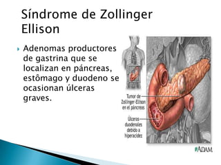  Adenomas productores
de gastrina que se
localizan en páncreas,
estômago y duodeno se
ocasionan úlceras
graves.
Síndrome de Zollinger
Ellison
 