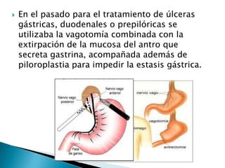  En el pasado para el tratamiento de úlceras
gástricas, duodenales o prepilóricas se
utilizaba la vagotomía combinada con la
extirpación de la mucosa del antro que
secreta gastrina, acompañada además de
piloroplastia para impedir la estasis gástrica.
 