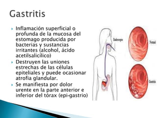  Inflamación superficial o
profunda de la mucosa del
estomago producida por
bacterias y sustancias
irritantes (alcohol, ácido
acetilsalicílico)
 Destruyen las uniones
estrechas de las células
epiteliales y puede ocasionar
atrofia glandular.
 Se manifiesta por dolor
urente en la parte anterior e
inferior del tórax (epi-gastrio)
 