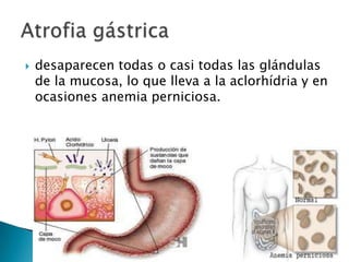  desaparecen todas o casi todas las glándulas
de la mucosa, lo que lleva a la aclorhídria y en
ocasiones anemia perniciosa.
 