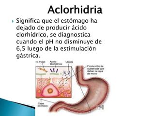 Significa que el estómago ha
dejado de producir ácido
clorhídrico, se diagnostica
cuando el pH no disminuye de
6,5 luego de la estimulación
gástrica.
Aclorhidria
 