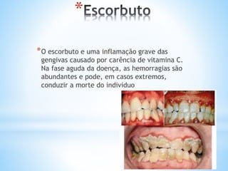 *
*O escorbuto e uma inflamação grave das
gengivas causado por carência de vitamina C.
Na fase aguda da doença, as hemorragias são
abundantes e pode, em casos extremos,
conduzir a morte do individuo
 