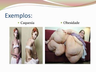 Exemplos:
 Caquexia  Obesidade
 