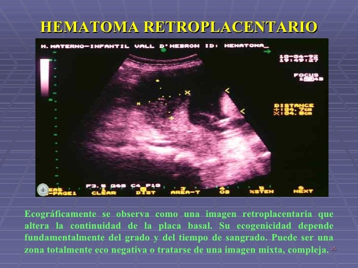 HEMATOMA RETROPLACENTARIO PDF