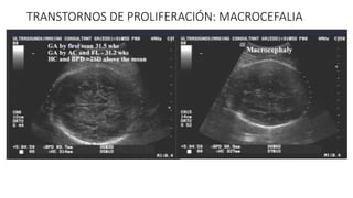 TRANSTORNOS DE PROLIFERACIÓN: MACROCEFALIA
 