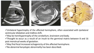 Unilateral hypertrophy of the affected hemisphere, often associated with ipsilateral
ventricular dilatation and midline shift.
May be hemihypertrophy of the cerebellum, brainstem and body.
Thought to occur as a result of an insult to the germinal matrix between 8 and 16
post menstrual weeks of gestation.
May find focal increased echogenicity of the affected hemisphere.
No abnormal karyotypic abnormality has been described.
 