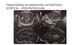 TRANSTORNOS DE MIGRACIÓN: HETEROTOPIA
(CORTICAL – PERIVENTRICULAR)
 