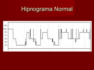 Hipnograma NormalHipnograma Normal
 