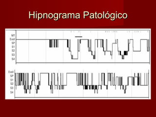 Hipnograma PatológicoHipnograma Patológico
 