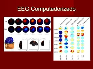 EEG ComputadorizadoEEG Computadorizado
 