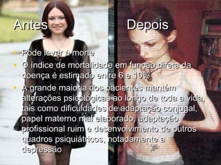 Antes DepoisAntes Depois
• Pode levar à mortePode levar à morte
• O índice de mortalidade em função direta daO índice de mortalidade em função direta da
doença é estimado entre 6 e 10%doença é estimado entre 6 e 10%
• A grande maioria dos pacientes mantémA grande maioria dos pacientes mantém
alterações psicológicas ao longo de toda a vida,alterações psicológicas ao longo de toda a vida,
tais como dificuldades de adaptação conjugal,tais como dificuldades de adaptação conjugal,
papel materno mal elaborado, adaptaçãopapel materno mal elaborado, adaptação
profissional ruim e desenvolvimento de outrosprofissional ruim e desenvolvimento de outros
quadros psiquiátricos, notadamente aquadros psiquiátricos, notadamente a
depressãodepressão
 