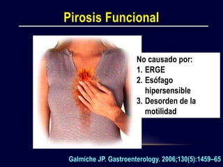 Transtornos funcionales del esófago Slide 6