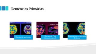 Demências Primárias
Doença de Alzheimer
Doença de Pick
(frontotemporal)
Doença dos corpúsculos
de Lewy
 