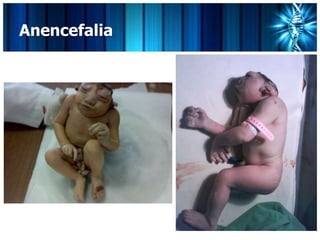 Anencefalia
 