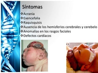 Acrania
Exencefalia
Raquisquisis
Ausencia de los hemisferios cerebrales y cerebelo
Anomalías en los rasgos faciales
Defectos cardíacos
Síntomas
 