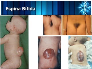 Espina Bífida
 