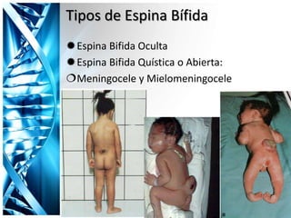 Tipos de Espina Bífida
Espina Bifida Oculta
Espina Bifida Quística o Abierta:
Meningocele y Mielomeningocele
 