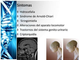 Sintomas
◊ Hidrocefalia
◊ Sindrome de Arnold-Chiari
◊ Siringomielia
◊ Alteraciones del aparato locomotor
◊ Trastornos del sistema genito-urinario
◊ Criptorquidia
 