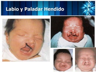 Labio y Paladar Hendido
 