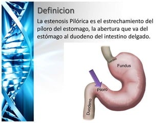 La estenosis Pilórica es el estrechamiento del
píloro del estomago, la abertura que va del
estómago al duodeno del intestino delgado.
Definicion
Fundus
 