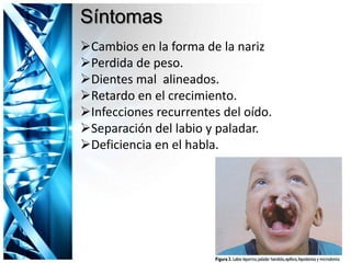 Síntomas
Cambios en la forma de la nariz
Perdida de peso.
Dientes mal alineados.
Retardo en el crecimiento.
Infecciones recurrentes del oído.
Separación del labio y paladar.
Deficiencia en el habla.
 