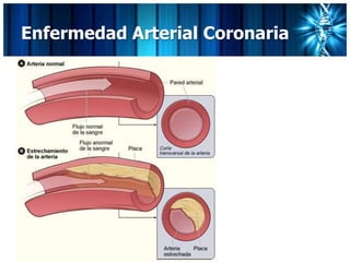 Enfermedad Arterial Coronaria
 